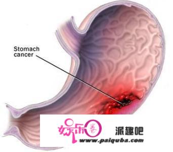 为什么全球胃癌一半都在中国？