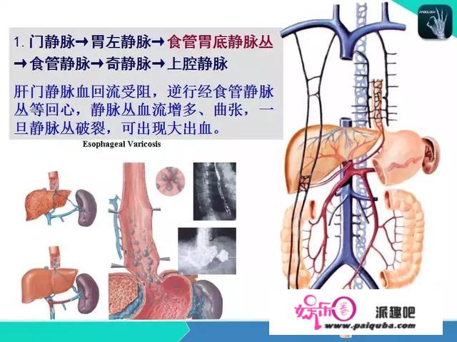 多例危重患者突发呕血！秋冬季为何肝硬化病人出血高发？