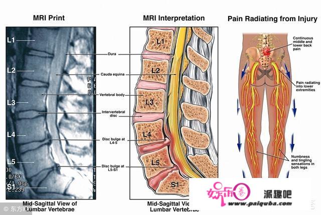 腰椎间盘突出非常难受，腿麻腿疼，该怎么办？