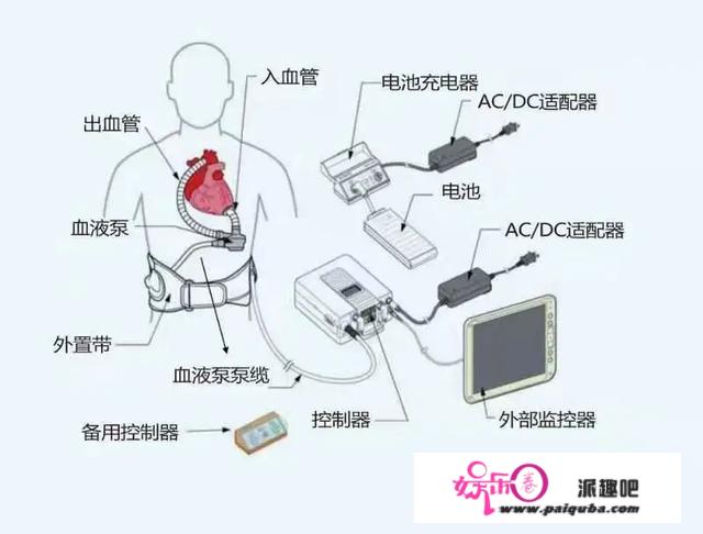 植入一颗“机械心脏”是什么样的体验？浙大二院人工心脏植入患者今日出院