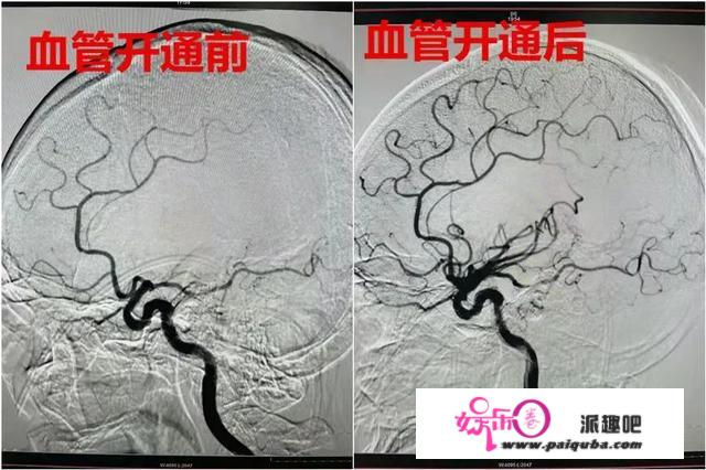 太吓人！静点头孢后喝了二两白酒......