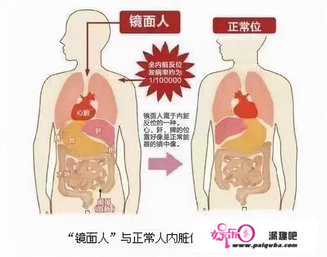 稀有！“镜像人”内脏完全反位，食管癌手术医生需要摆布手互换