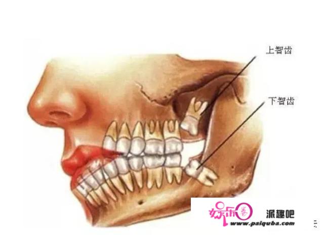 智齿必然要拔吗？呈现那种情况，请及时拔掉智齿