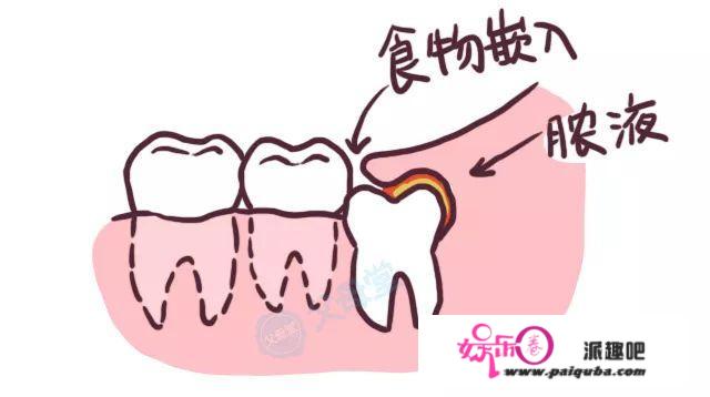 智齿除了疼还有啥用？那3个隐藏技能相知恨晚