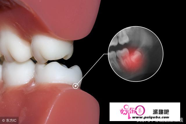 为什么要拔智齿？口腔科医生向各人实话实说